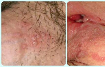 Herpes simplex — особенности заболевания Лечение вируса простого герпеса 1 и 2 типа