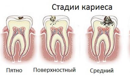 Кариес в стоматологии: причины, симптомы и стадии развития с фото, лечение зубов От чего развивается кариес чр